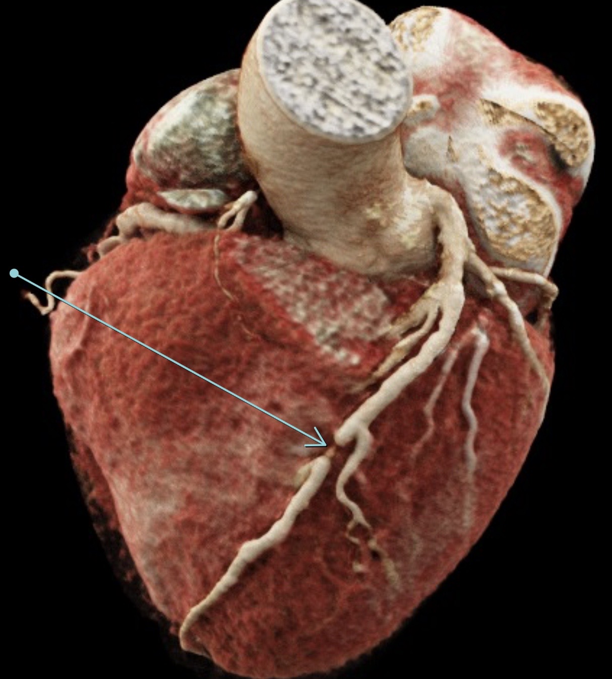 Hightech-Diagnostik und Therapie zur Herzinfarkt-Prävention