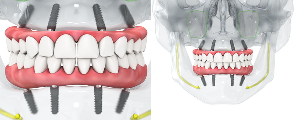 Feste Zähne in einem Tag - Revolution für Lebensqualität mit Zahnimplantaten