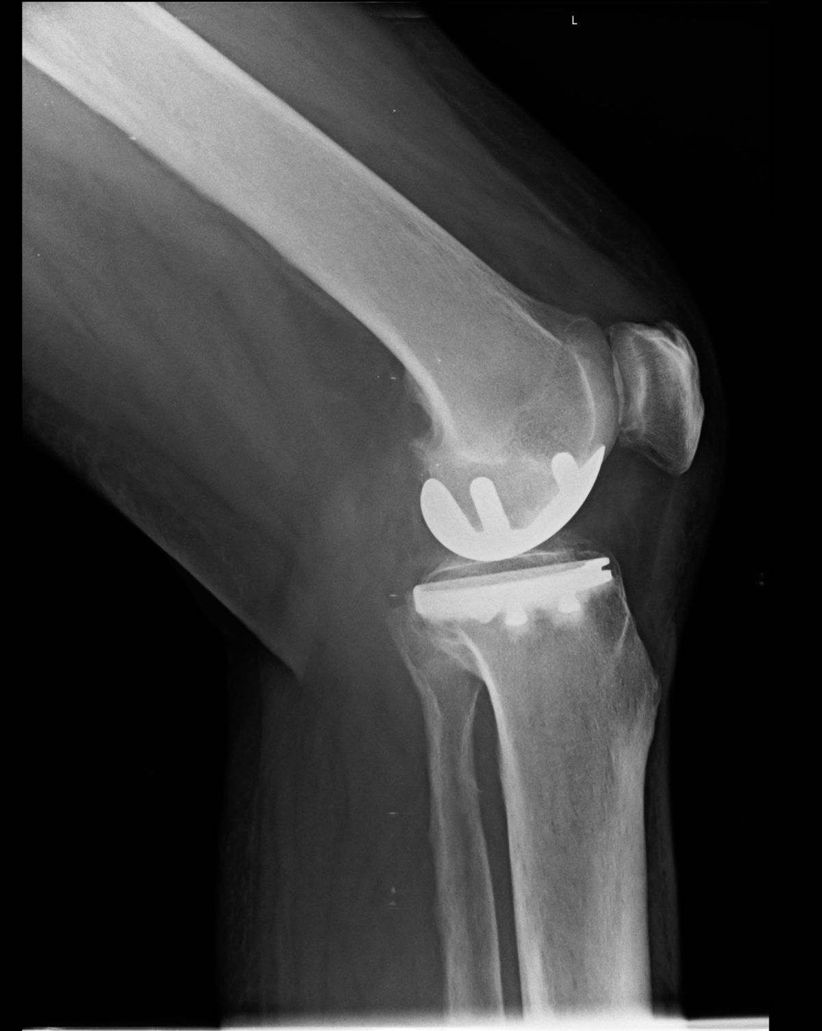 Kniearthrose: Es muss nicht immer eine ganze Prothese sein